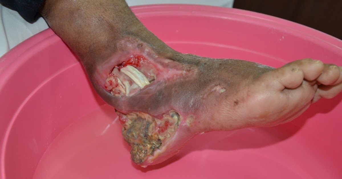 Diabetes Terengganu: Diabetes Foot Ulcer Yang Mengerikan